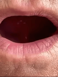 Prótesis Dental Completa con Soporte Esquelético (Sonrisa Firme y Natural)